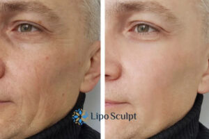 How to Fight Aging Symptoms 3 Fight Aging Symptoms Lancaster With HIFU and Morpheus8 Today!
