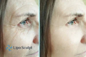 How to Fight Aging Symptoms 2 Do you want to Fight Aging Symptoms Lancaster? Contact Lipo Sculpt today!