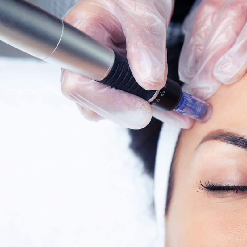 Morpheus8 treatment Lancaster from Lipo Sculpt - Book in today!